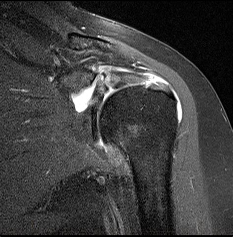 mri for torn muscles